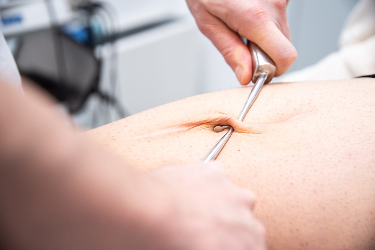 rehability lugano fisioterapia trattamento cicatrice con fibrolisi